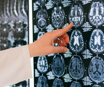 Brain biomarker that could allow early Alzheimer’s detection found